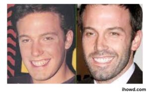 Ben Affleck Teeth Before And After